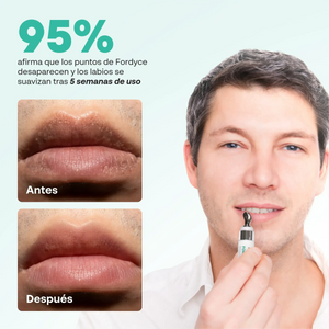 Antes y después del uso de la crema Abera Fordyce en labios masculinos con reducción visible de puntos de Fordyce