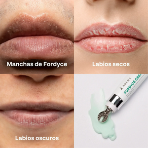 Problemas comunes de labios como manchas de Fordyce, labios secos y oscuros tratados con Abera Fordyce Cream