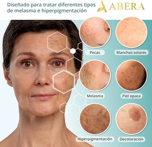 Diferentes tipos de melasma e hiperpigmentación tratados con el suero facial Abera