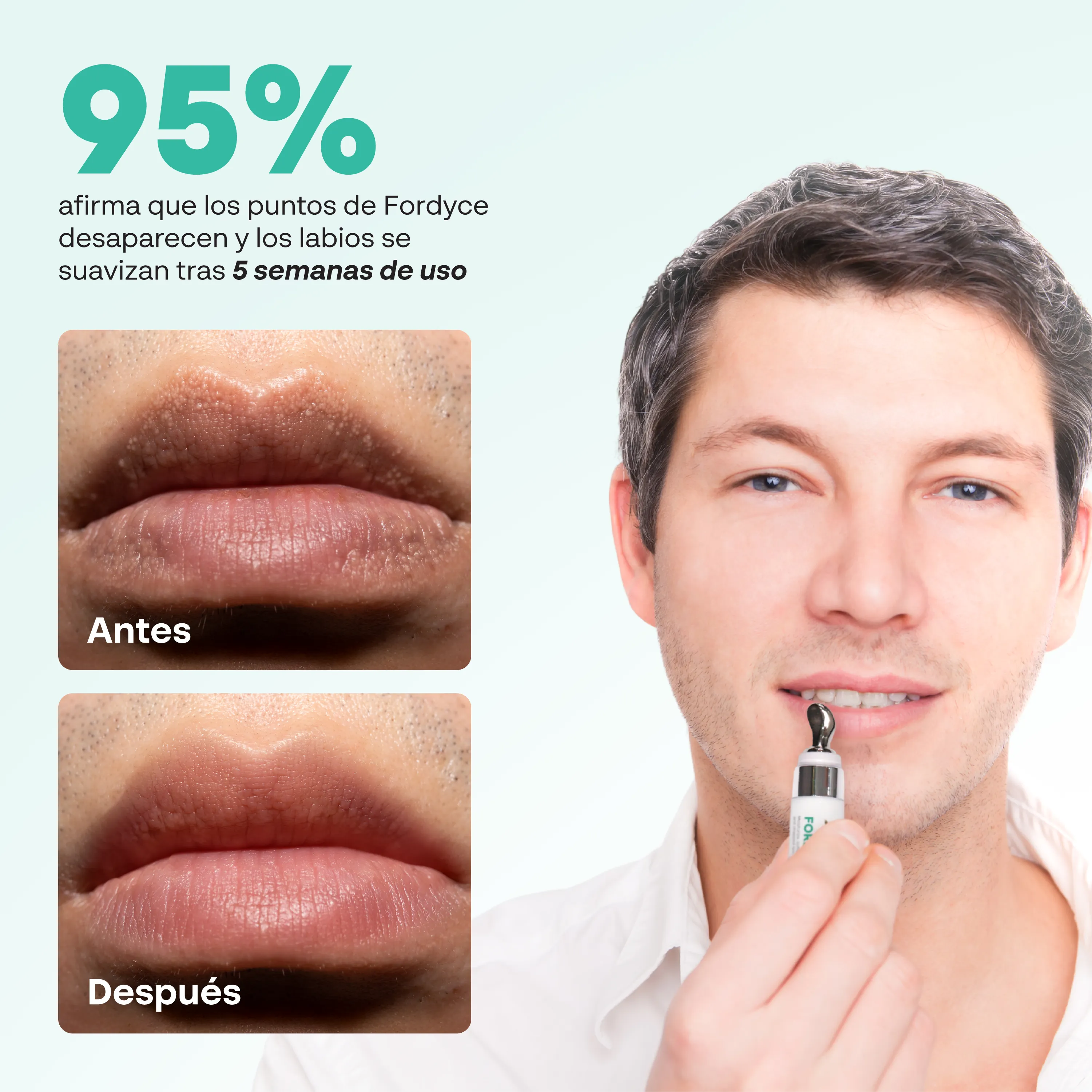 Antes y después del uso de la crema Abera Fordyce en labios masculinos con reducción visible de puntos de Fordyce