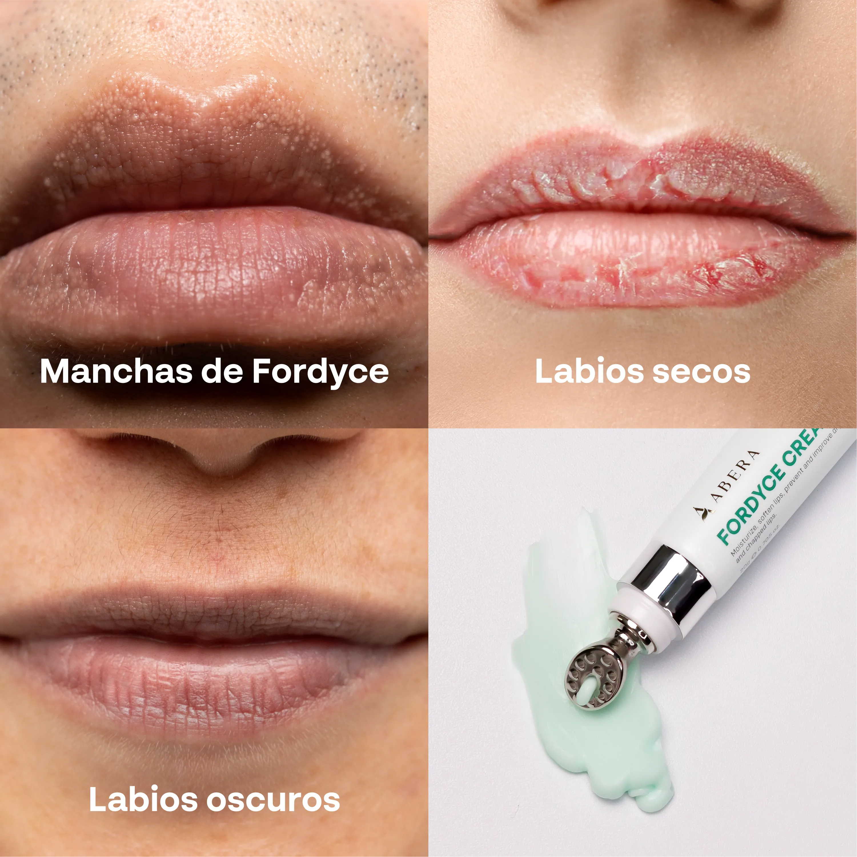 Problemas comunes de labios como manchas de Fordyce, labios secos y oscuros tratados con Abera Fordyce Cream